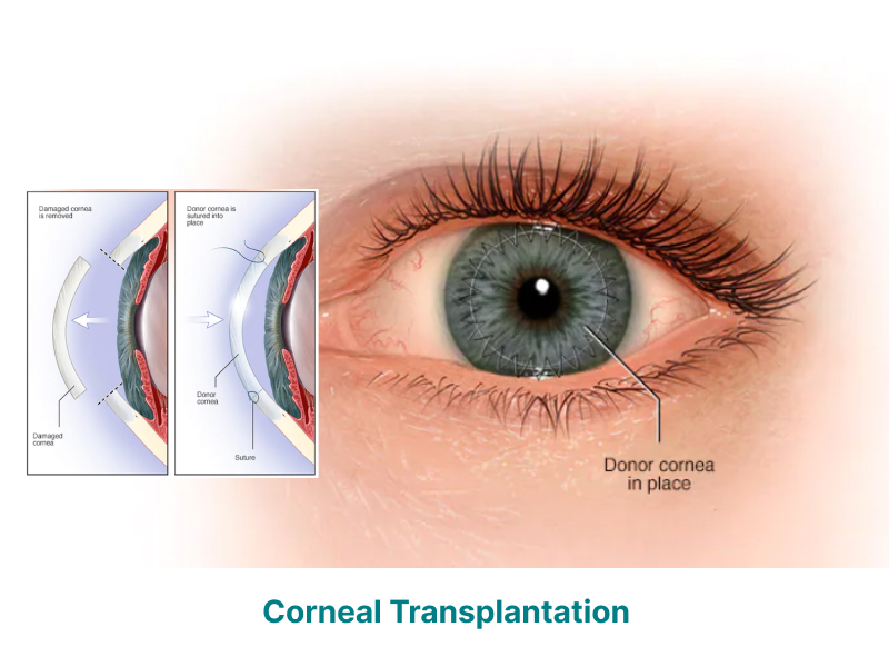 Corneal Transplantation